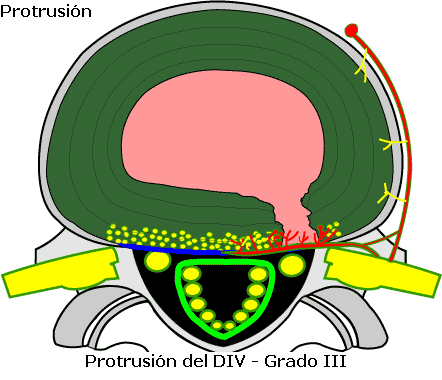 protrusion_discal_grado_tres_