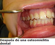 mandibula_despues_de_una_osteomielitis_dental