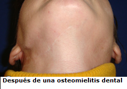 despues_de_una_osteomielitis_dental
