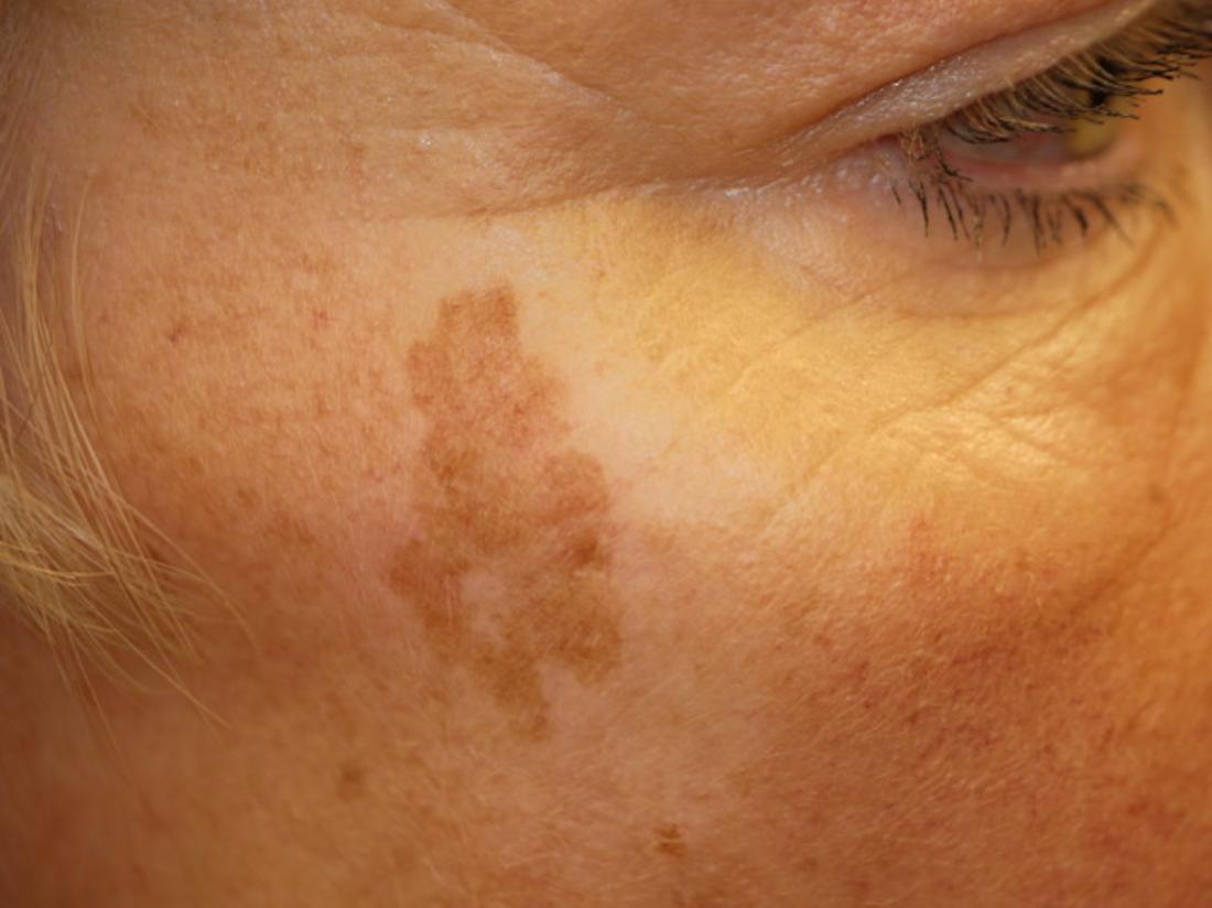 3_2_24_age-spot-or-liver-spot-on-the-face-br-image-credit-dermnet-new-zealand-br.jpg