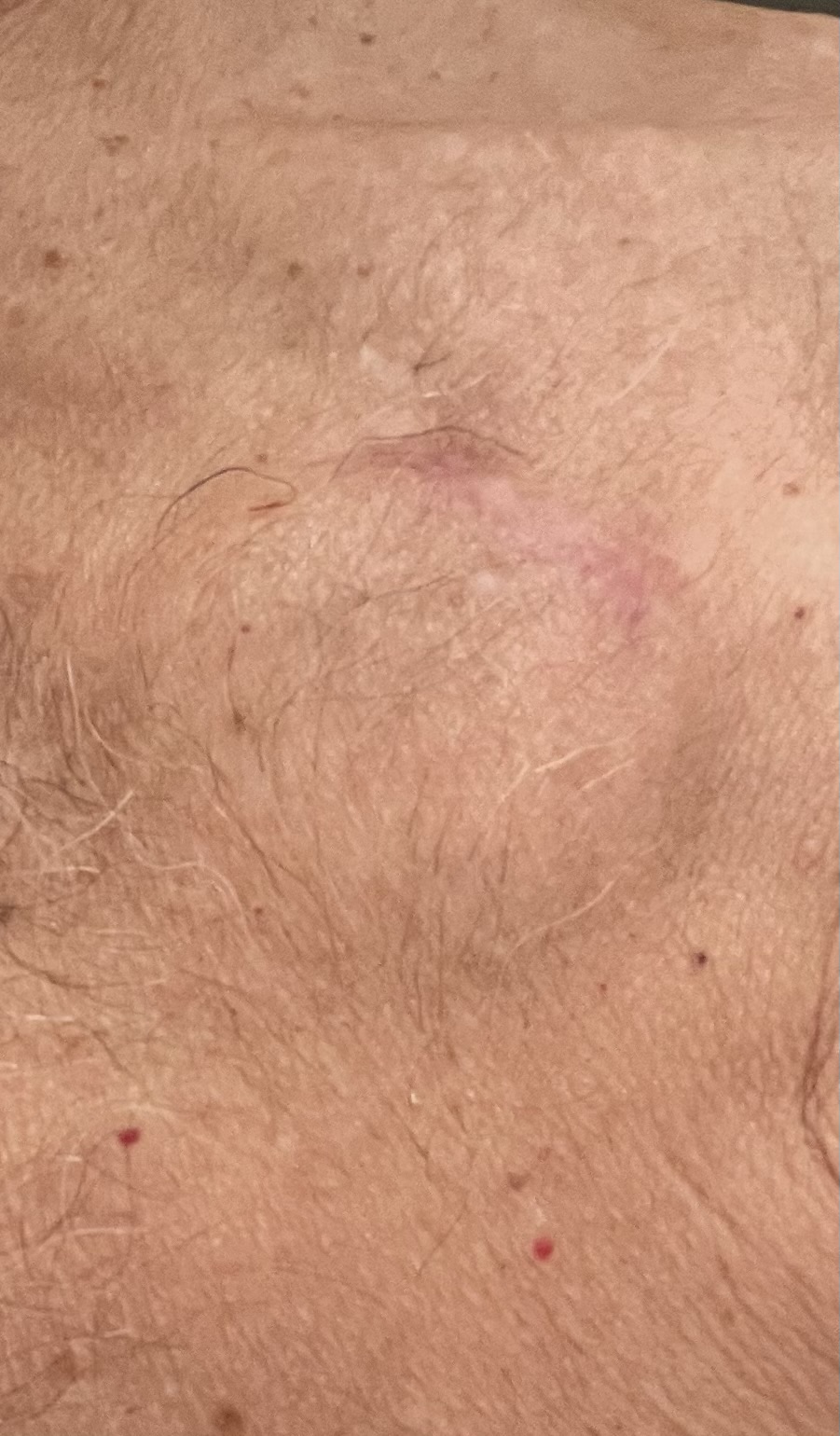 Left bundle branch area pacing (LBBAP) device-pocket incision approximately 70 days after implantation, showing a closed scar with a fading pink discoloration line.