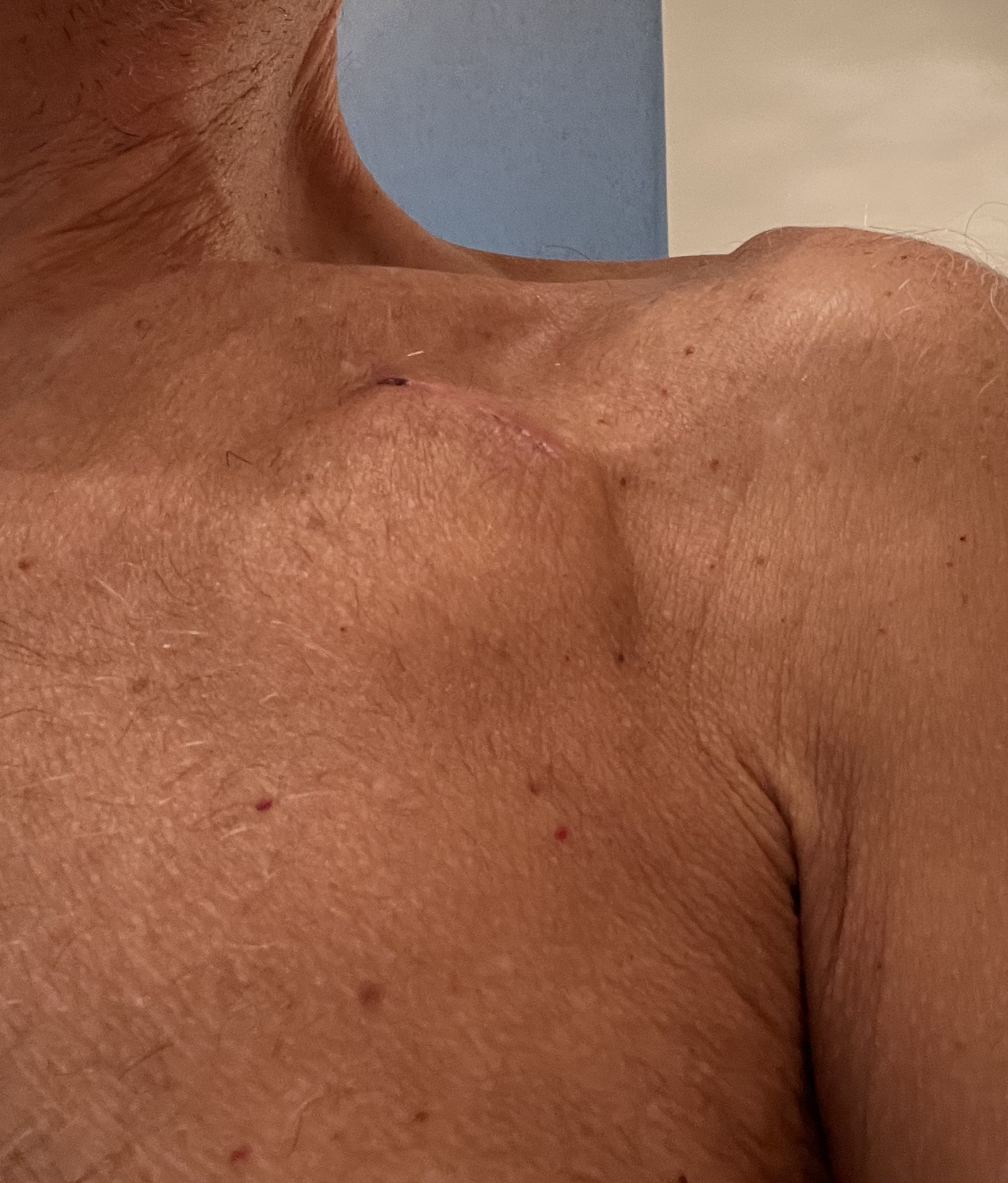 LBBAP pacemaker pocket incision 2 weeks after the procedure, showing an early healing incision with residual suture mark and surrounding erythema