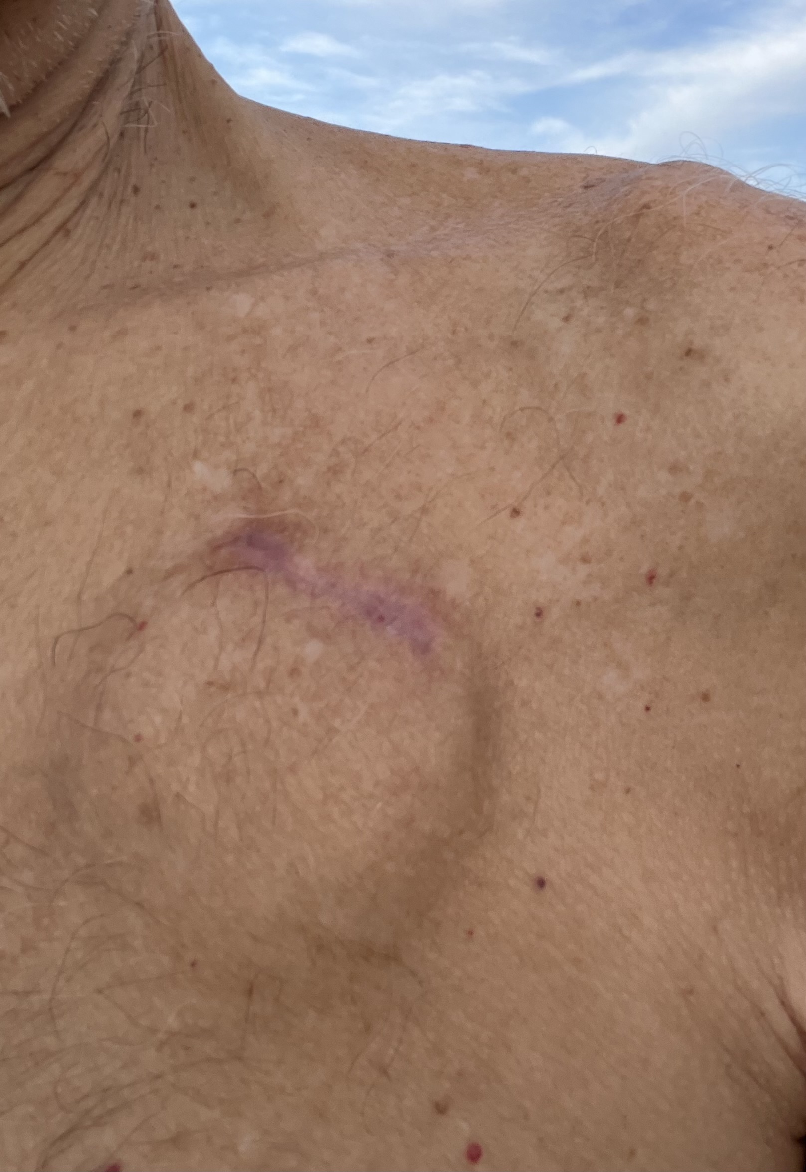 LBBAP pacemaker pocket incision 7 weeks after the procedure, showing a maturing linear scar with violaceous discoloration